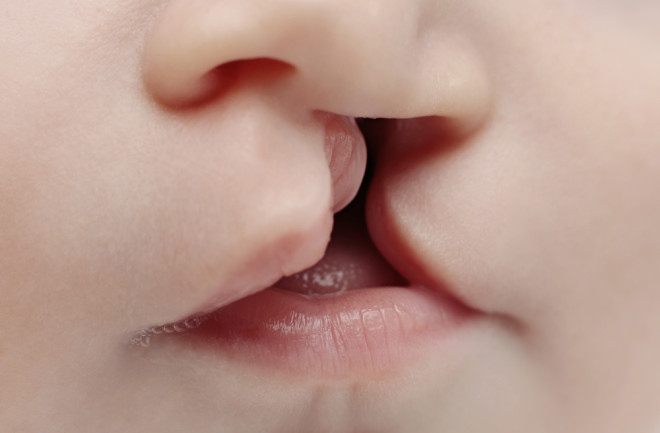 What are cleft lip and palate?