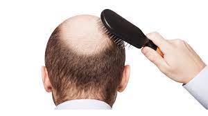 Find an authentic new hair loss treatment for men