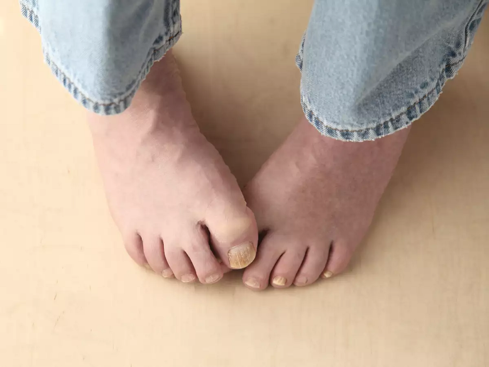 How Can You Prevent Foot and Toenail Fungus?