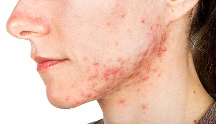 WHAT CAUSES ACNE SPOTS & HOW DO YOU TREAT THEM?